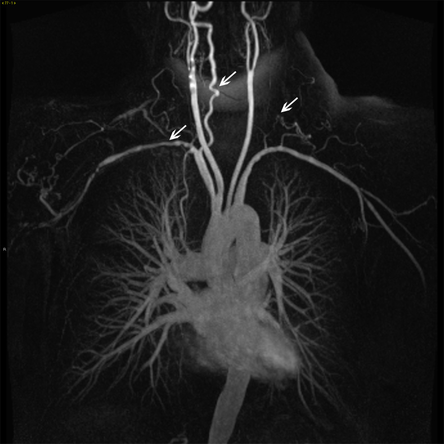 https://www.msdmanuals.com/-/media/manual/professional/images/19a-images-of-aorta-in-takayasu-arteritis-ctisus.jpg?thn=0&sc_lang=en