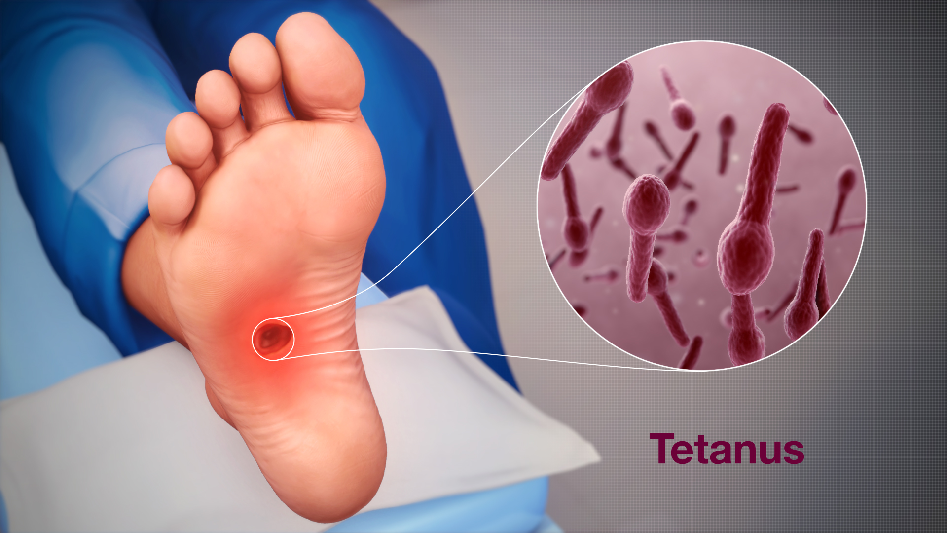 Tetanus: symptomen, oorzaken en behandeling