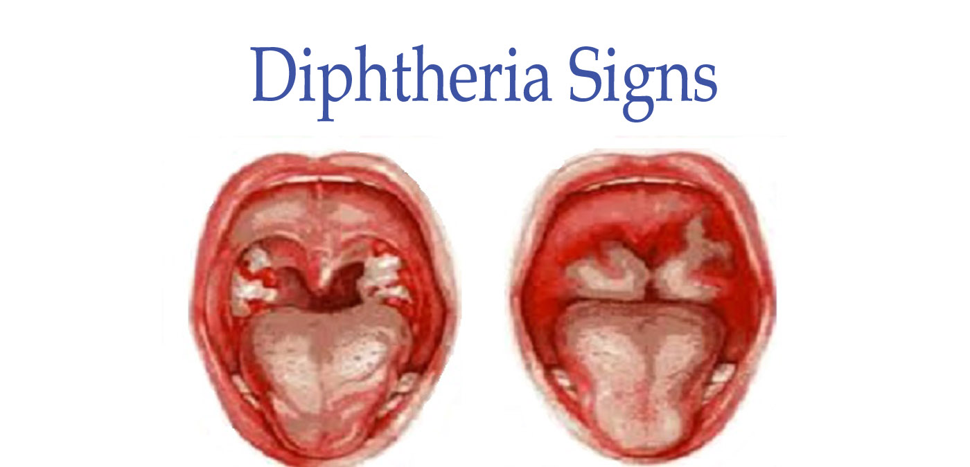 Difterie: oorzaken, symptomen en behandeling