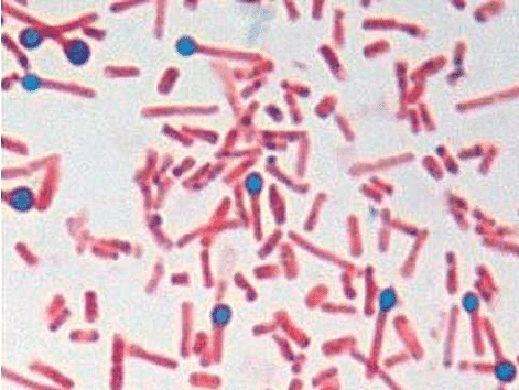 een.  Sporen en bacteriën van Clostridium tetani met een typische trommelstokvorm geïsoleerd uit de korst van de onthoornende wonden in geval 1 (gram-kleuring-1000x). 
