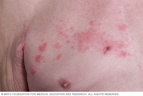 Gordelroos (herpes zoster): oorzaken, symptomen en behandeling