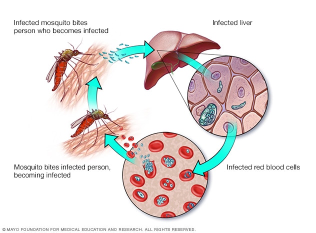Malaria: oorzaken, symptomen en behandeling