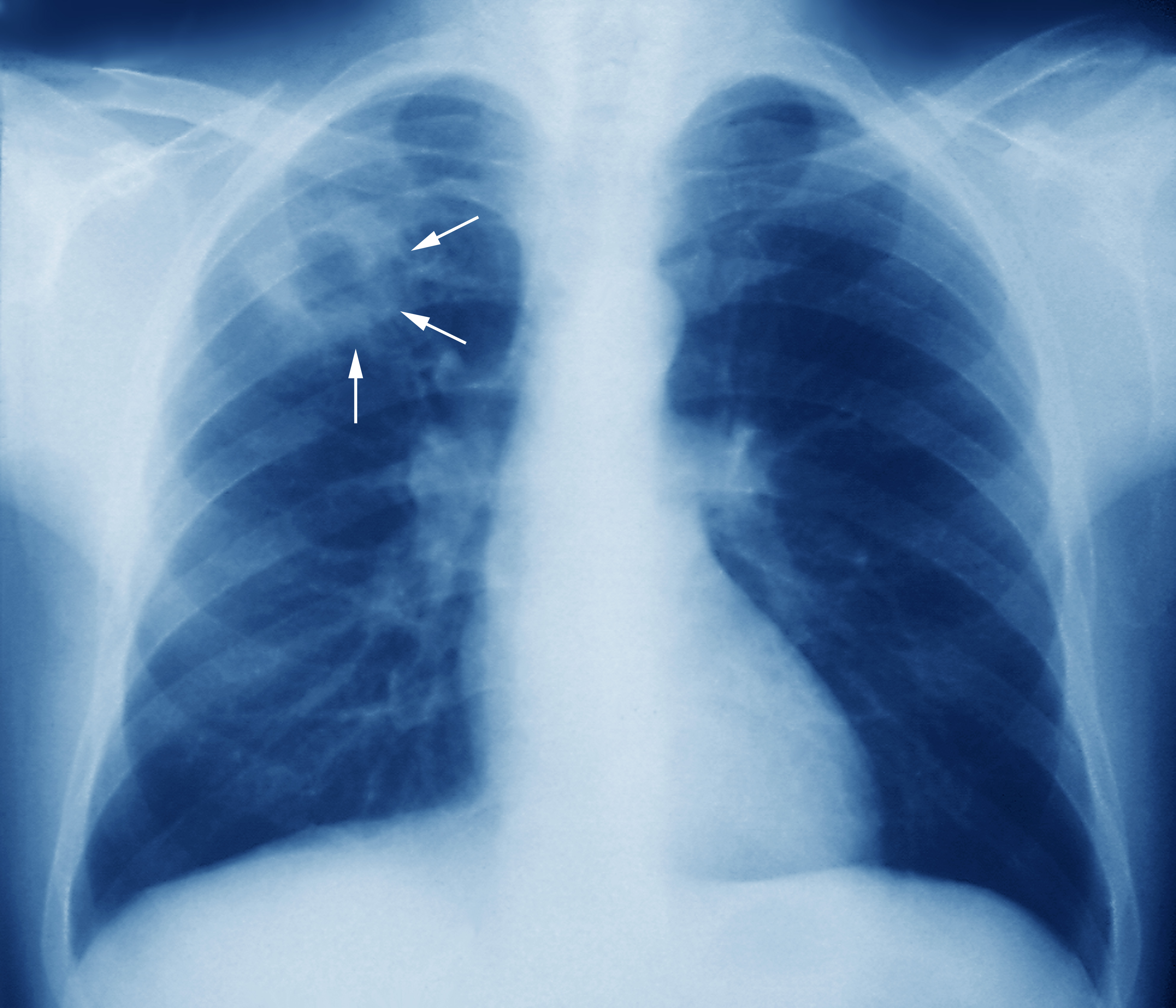 https://mednl.net/wp-content/uploads/2020/12/m2700245-tuberculosis-chest-x-ray-science-photo-library-high.jpg