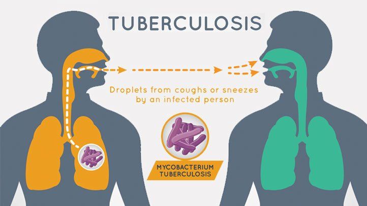 Tuberculose: oorzaken, symptomen en behandeling