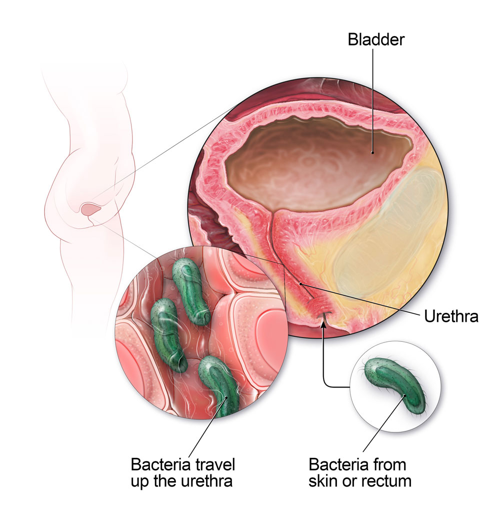 Bij vrouwen kunnen bacteriën uit de huid of het rectum de urethra opgaan en een blaasontsteking veroorzaken.