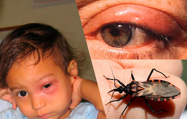 Ziekte van Chagas: symptomen, oorzaken en behandeling