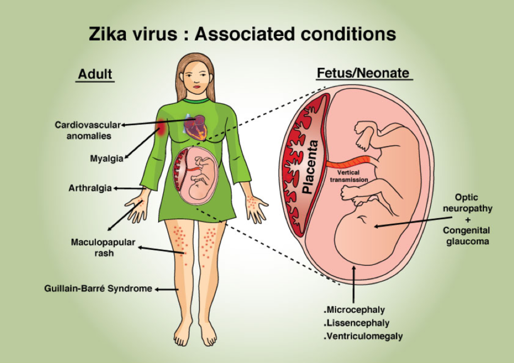 Complicaties van Zika-virusinfectie