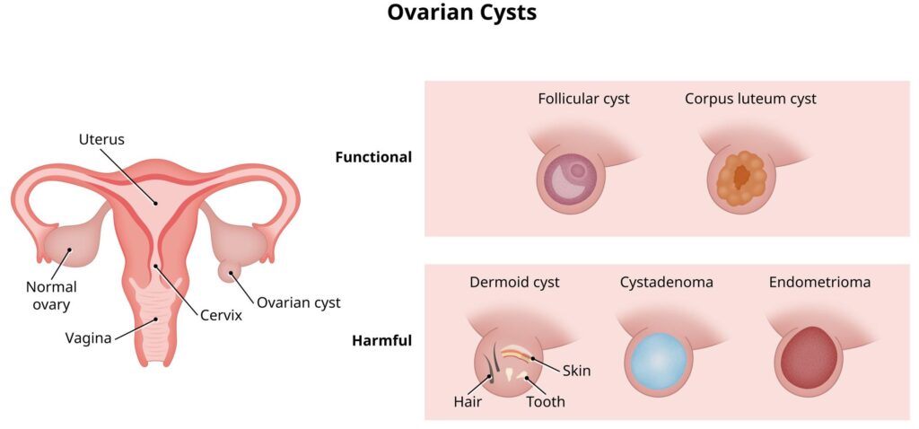 Ovariële cyste
