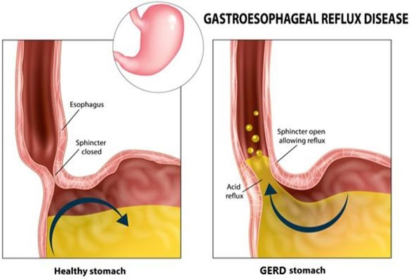 Gastro-oesofageale refluxziekte