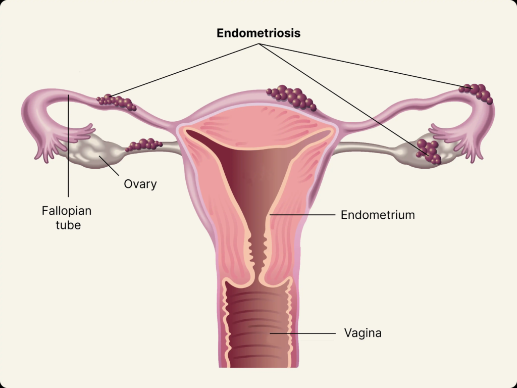 Endometriose