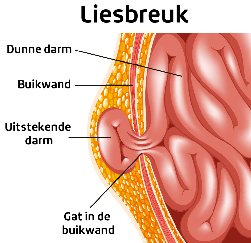 Liesbreuk