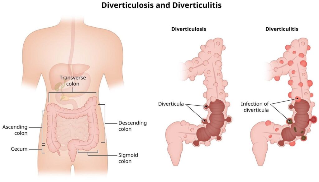 Diverticulose en diverticulitis