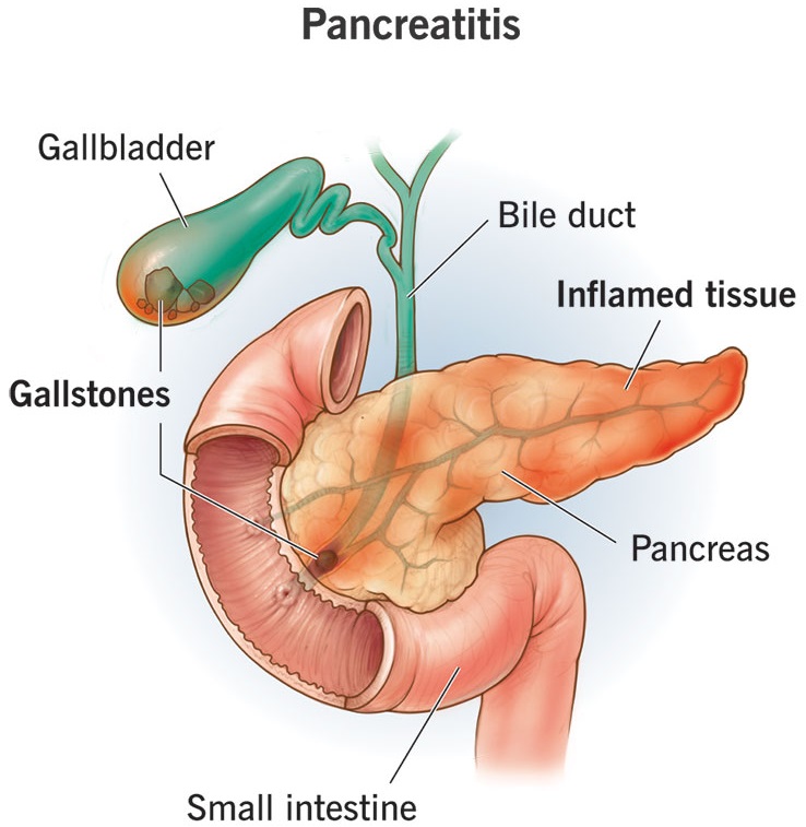 Pancreatitis