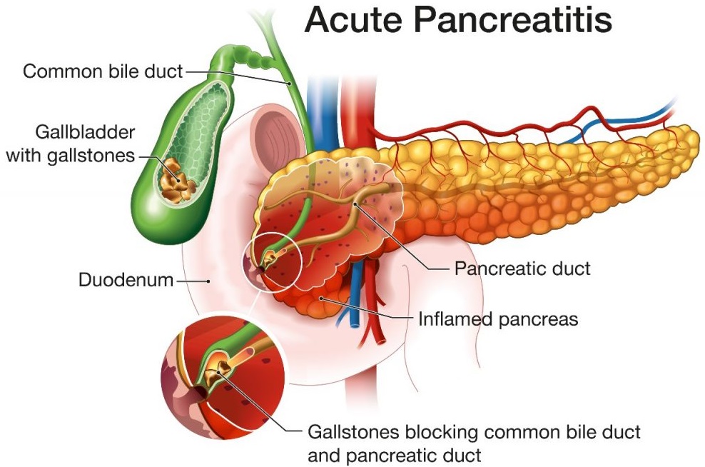 Acute pancreatitis