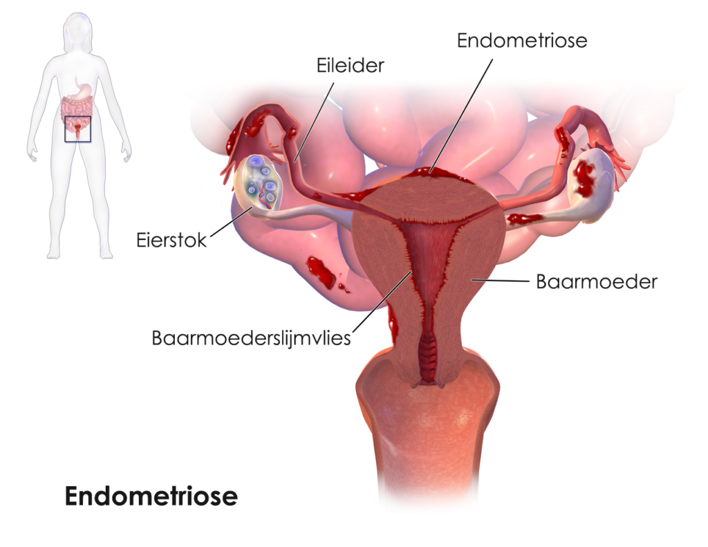 Waar kun je pijn voelen bij endometriose?