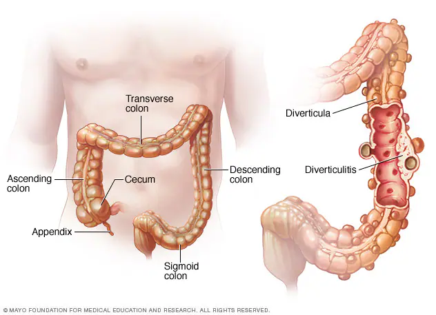 Diverticulitis