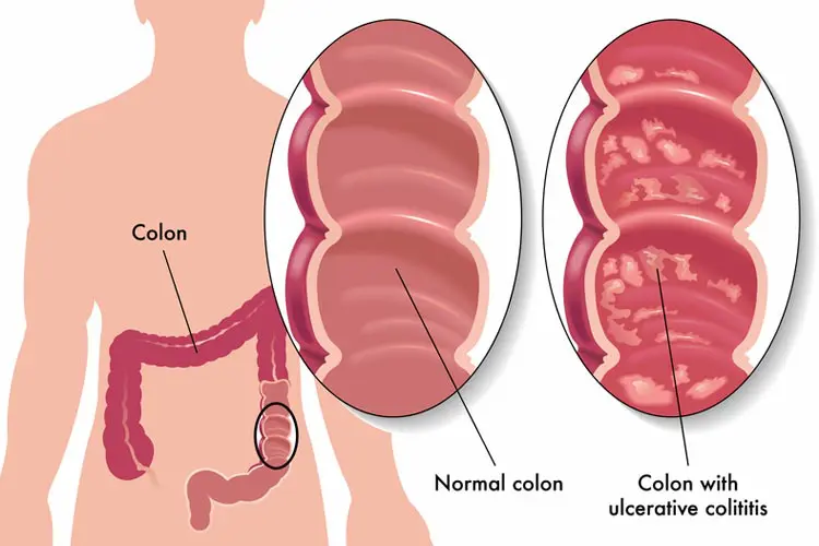 colitis ulcerosa