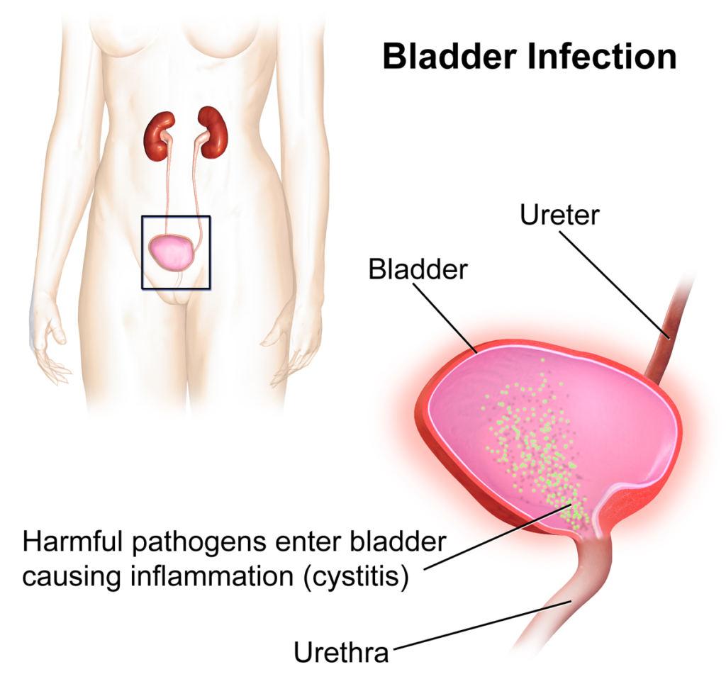 De beste medicijnen voor de behandeling van een blaasontsteking